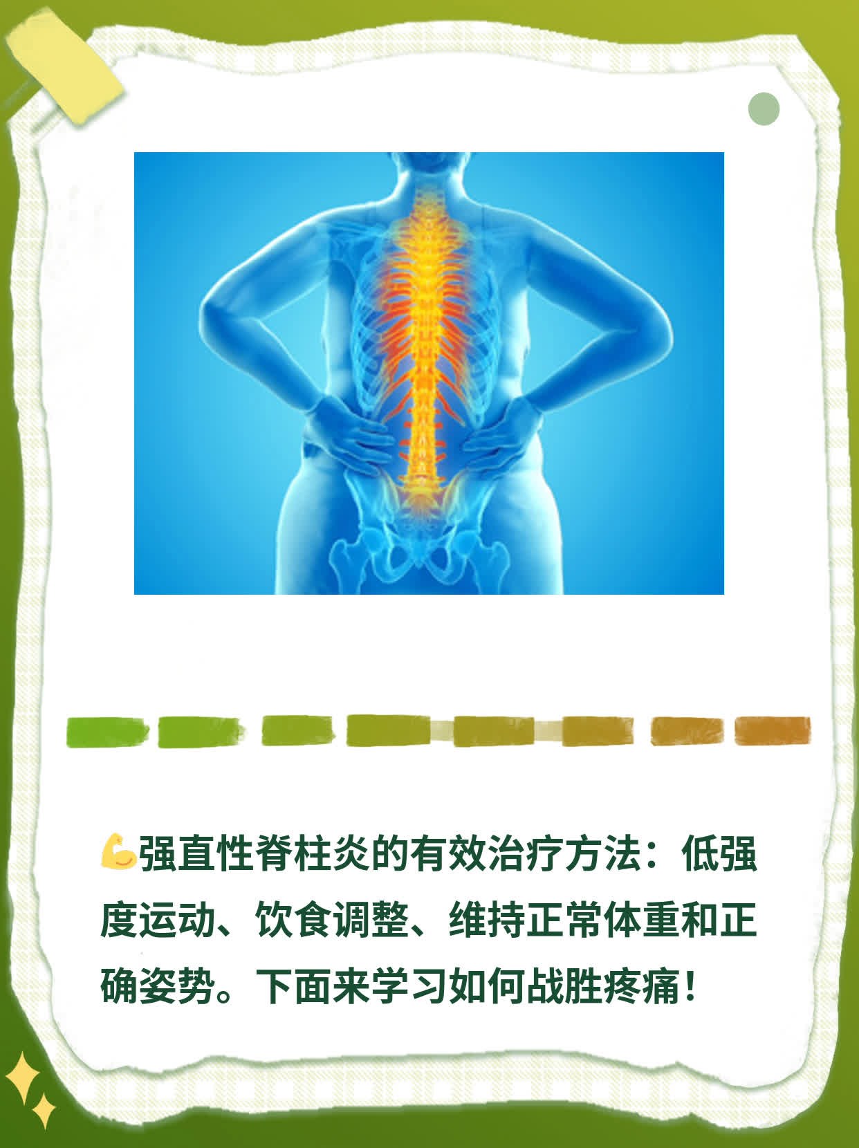 最新强直性脊柱炎治疗法，重拾自信，告别疼痛之路